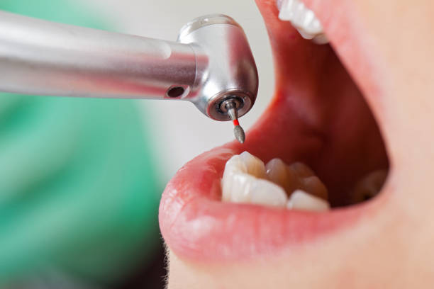 Best Emergency Tooth Extraction in Findlay, OH